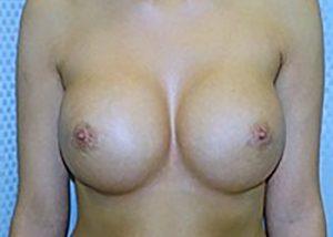 breast-revision-surgery-beverly-hills-woman-after-front-dr-maan-kattash