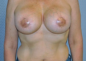 breast-revision-surgery-implants-los-angeles-woman-front-after-dr-maan-kattash