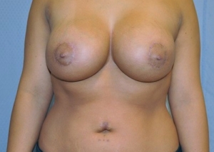 breast-revision-surgery-implants-scarring-los-angeles-woman-after-front-dr-maan-kattash