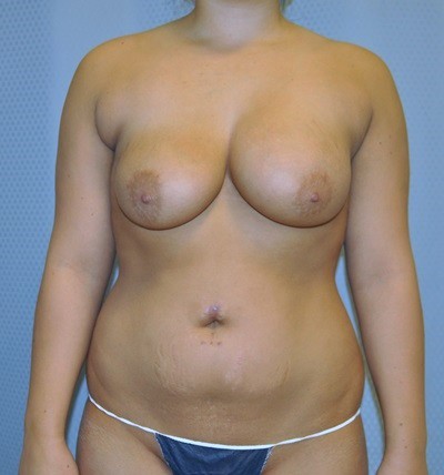 breast-revision-surgery-implants-scarring-los-angeles-woman-before-front-dr-maan-kattash