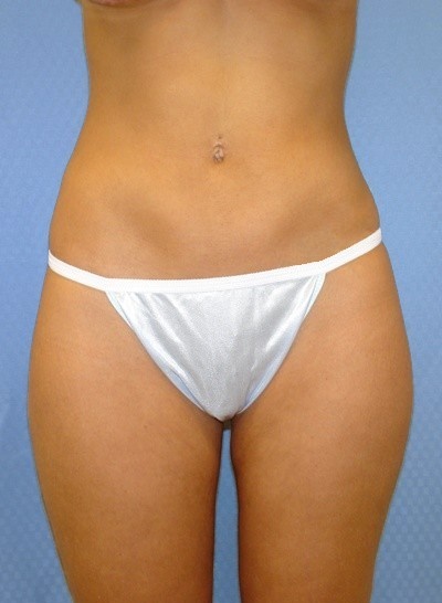 buttock-augmentation-brazilian-butt-lift-beverly-hills-woman-after-front-dr-maan-kattash