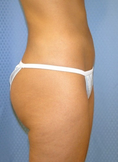buttock-augmentation-brazilian-butt-lift-beverly-hills-woman-after-side-dr-maan-kattash