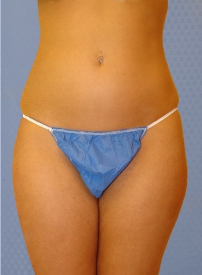 buttock-augmentation-brazilian-butt-lift-beverly-hills-woman-before-front-dr-maan-kattash