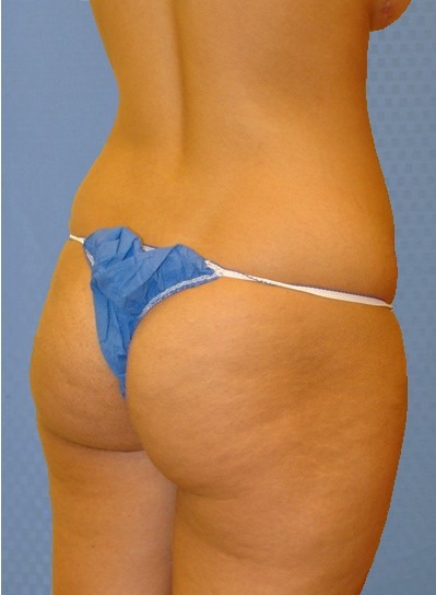 buttock-augmentation-brazilian-butt-lift-beverly-hills-woman-before-oblique-dr-maan-kattash
