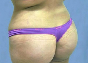 buttock-augmentation-brazilian-butt-lift-claremont-woman-after-back-dr-maan-kattash