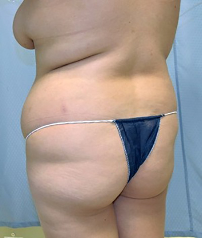 buttock-augmentation-brazilian-butt-lift-claremont-woman-before-back-dr-maan-kattash