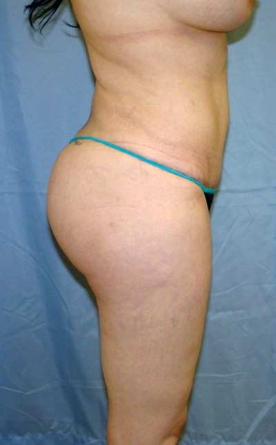 buttock-augmentation-brazilian-butt-lift-los-angeles-woman-after-side-dr-maan-kattash