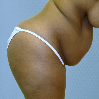 buttock-augmentation-brazilian-butt-lift-rancho-cucamonga-woman-before-bend-dr-maan-kattash