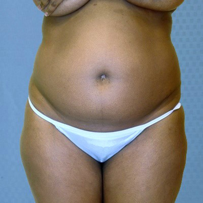buttock-augmentation-brazilian-butt-lift-rancho-cucamonga-woman-before-front-dr-maan-kattash
