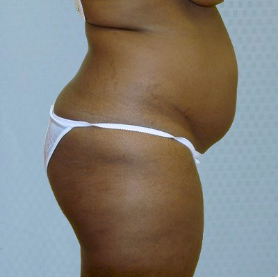 buttock-augmentation-brazilian-butt-lift-rancho-cucamonga-woman-before-side-dr-maan-kattash