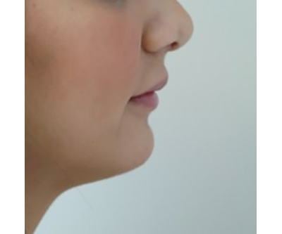 chin-augmentation-cheek-plastic-surgery-beverly-hills-woman-after-side-dr-maan-kattash
