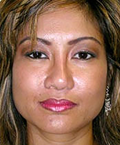 chin-augmentation-cheek-plastic-surgery-rancho-cucamonga-woman-after-front-dr-maan-kattash-2