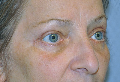 eyelid-lift-blepharoplasty-cosmetic-surgery-rancho-cucamonga-woman-after-front-dr-maan-kattash (3)