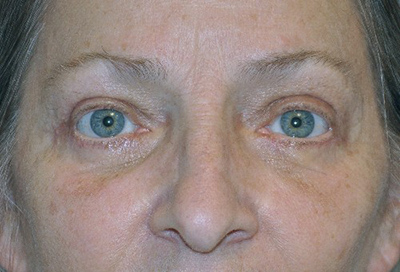 eyelid-lift-blepharoplasty-cosmetic-surgery-rancho-cucamonga-woman-after-front-dr-maan-kattash