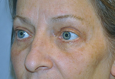 eyelid-lift-blepharoplasty-cosmetic-surgery-rancho-cucamonga-woman-after-left-ob-dr-maan-kattash