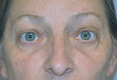 eyelid-lift-blepharoplasty-cosmetic-surgery-rancho-cucamonga-woman-before-front-dr-maan-kattash