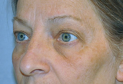 eyelid-lift-blepharoplasty-cosmetic-surgery-rancho-cucamonga-woman-before-left-ob-dr-maan-kattash
