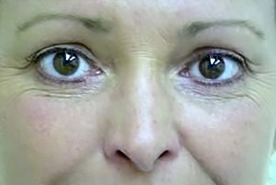 eyelid-lift-blepharoplasty-cosmetic-surgery-upland-woman-after-front-dr-maan-kattash
