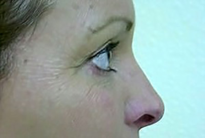 eyelid-lift-blepharoplasty-cosmetic-surgery-upland-woman-after-side-dr-maan-kattash