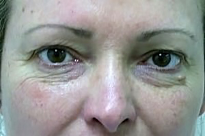 eyelid-lift-blepharoplasty-cosmetic-surgery-upland-woman-before-front-dr-maan-kattash