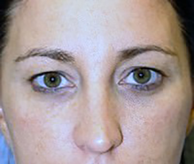 eyelid-lift-blepharoplasty-plastic-surgery-beverly-hills-woman-before-front-dr-maan-kattash
