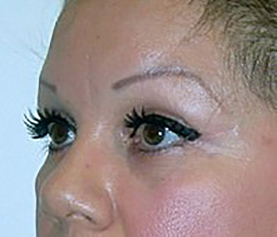 eyelid-lift-blepharoplasty-plastic-surgery-claremont-after-oblique-dr-maan-kattash