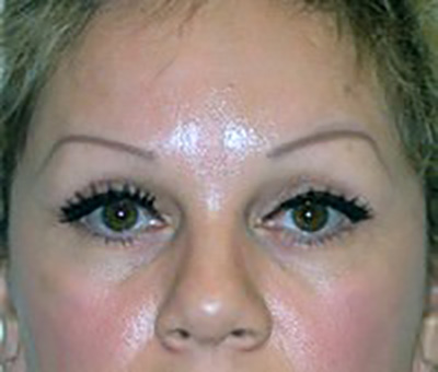 eyelid-lift-blepharoplasty-plastic-surgery-claremont-woman-after-front-dr-maan-kattash