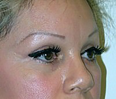eyelid-lift-blepharoplasty-plastic-surgery-claremont-woman-after-side-dr-maan-kattash
