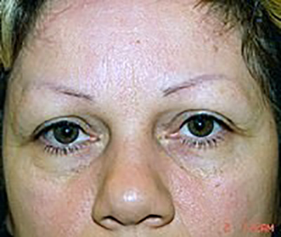 eyelid-lift-blepharoplasty-plastic-surgery-claremont-woman-before-front-dr-maan-kattash