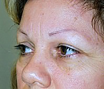 eyelid-lift-blepharoplasty-plastic-surgery-claremont-woman-before-oblique-dr-maan-kattash