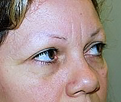 eyelid-lift-blepharoplasty-plastic-surgery-claremont-woman-before-side-dr-maan-kattash