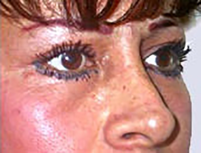 eyelid-lift-blepharoplasty-plastic-surgery-inland-empire-after-oblique-dr-maan-kattash-2