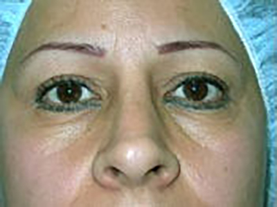 eyelid-lift-blepharoplasty-plastic-surgery-inland-empire-woman-before-front-dr-maan-kattash