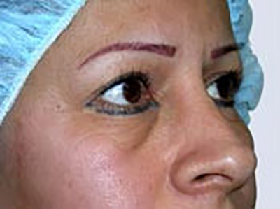 eyelid-lift-blepharoplasty-plastic-surgery-inland-empire-woman-before-oblique-dr-maan-kattash