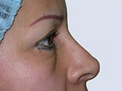 eyelid-lift-blepharoplasty-plastic-surgery-inland-empire-woman-before-side-dr-maan-kattash