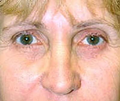 eyelid-lift-blepharoplasty-plastic-surgery-irvine-woman-after-front-dr-maan-kattash