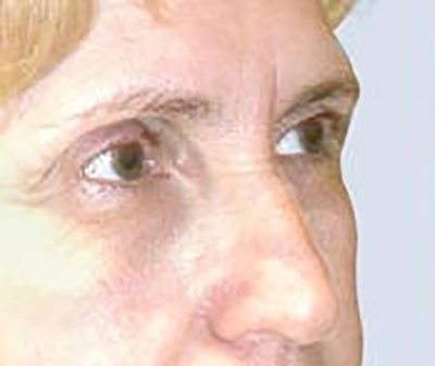 eyelid-lift-blepharoplasty-plastic-surgery-irvine-woman-before-oblique-dr-maan-kattash