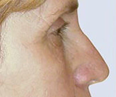eyelid-lift-blepharoplasty-plastic-surgery-irvine-woman-before-side-dr-maan-kattash