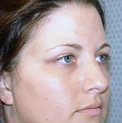 eyelid-lift-blepharoplasty-plastic-surgery-los-angeles-woman-before-oblique-dr-maan-kattash