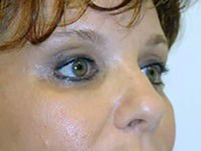 eyelid-lift-blepharoplasty-plastic-surgery-ontario-after-oblique-dr-maan-kattash
