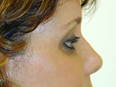 eyelid-lift-blepharoplasty-plastic-surgery-ontario-woman-after-side-dr-maan-kattash