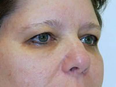 eyelid-lift-blepharoplasty-plastic-surgery-ontario-woman-before-oblique-dr-maan-kattash