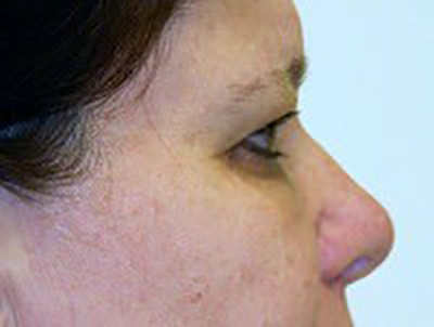eyelid-lift-blepharoplasty-plastic-surgery-ontario-woman-before-side-dr-maan-kattash