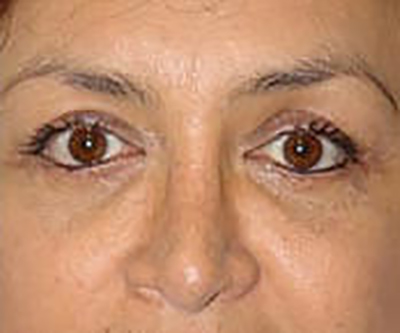 eyelid-lift-blepharoplasty-plastic-surgery-orange-county-woman-after-front-dr-maan-kattas