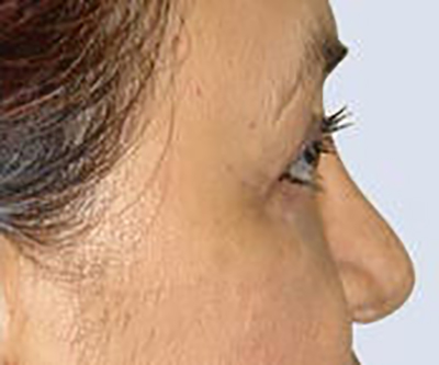 eyelid-lift-blepharoplasty-plastic-surgery-orange-county-woman-after-side-dr-maan-kattash