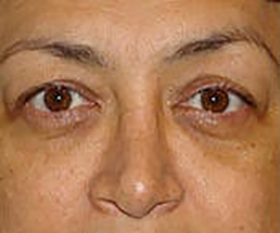 eyelid-lift-blepharoplasty-plastic-surgery-orange-county-woman-before-front-dr-maan-kattash