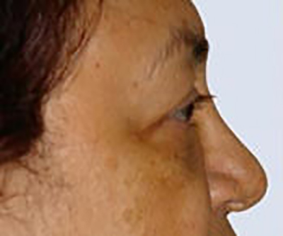 eyelid-lift-blepharoplasty-plastic-surgery-orange-county-woman-before-side-dr-maan-kattash