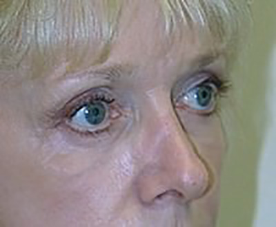 eyelid-lift-blepharoplasty-plastic-surgery-rancho-cucamonga-woman-after-oblique-dr-maan-kattash