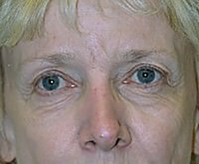 eyelid-lift-blepharoplasty-plastic-surgery-rancho-cucamonga-woman-before-front-dr-maan-kattash