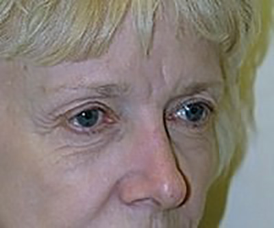 eyelid-lift-blepharoplasty-plastic-surgery-rancho-cucamonga-woman-before-oblique-dr-maan-kattash